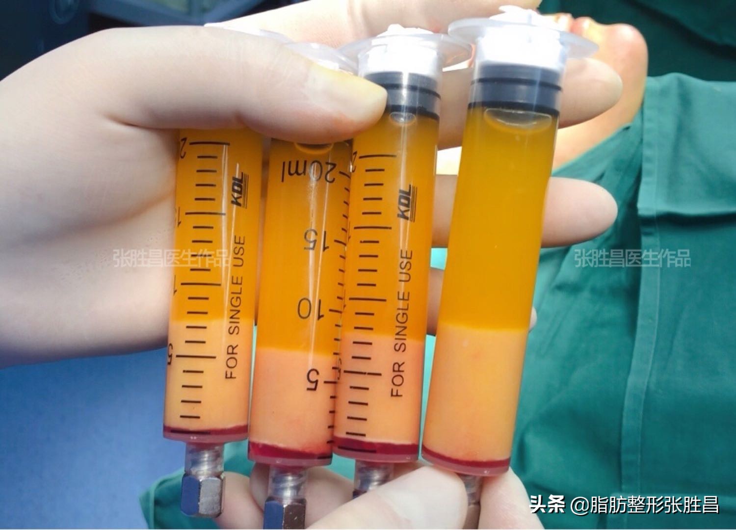 大腿环吸多长时间减腿围,大腿环吸后如何更好塑形