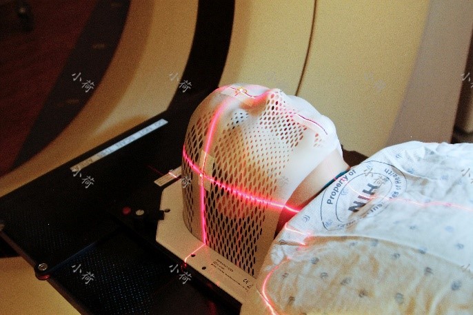 鼻咽癌治愈5年后流鼻血,从小到大流鼻血确诊鼻咽癌