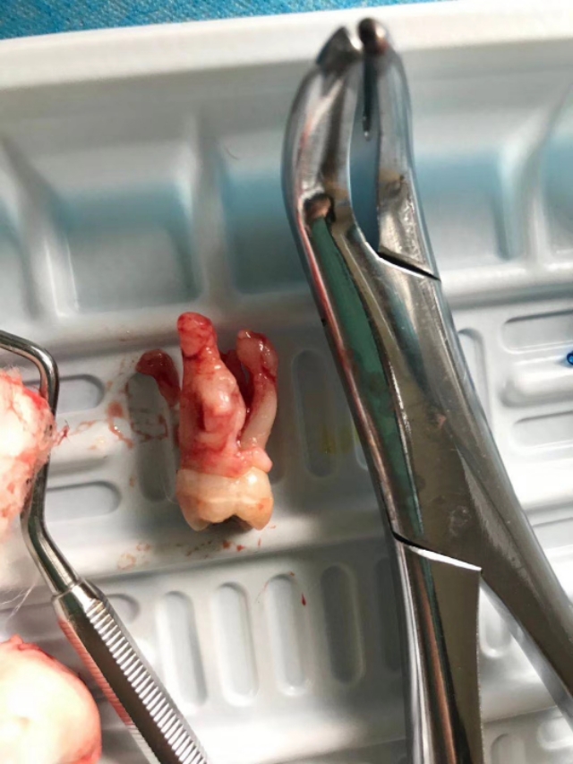 牙源性上颌窦炎牙龈瘘管,牙源性脓肿的症状