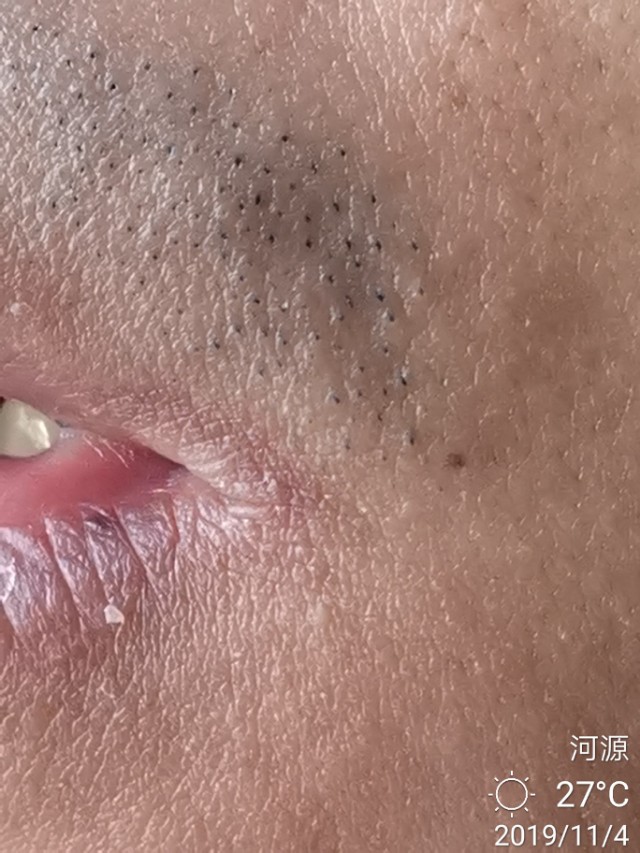 冬季多发口角炎(烂嘴角),中医怎么治?