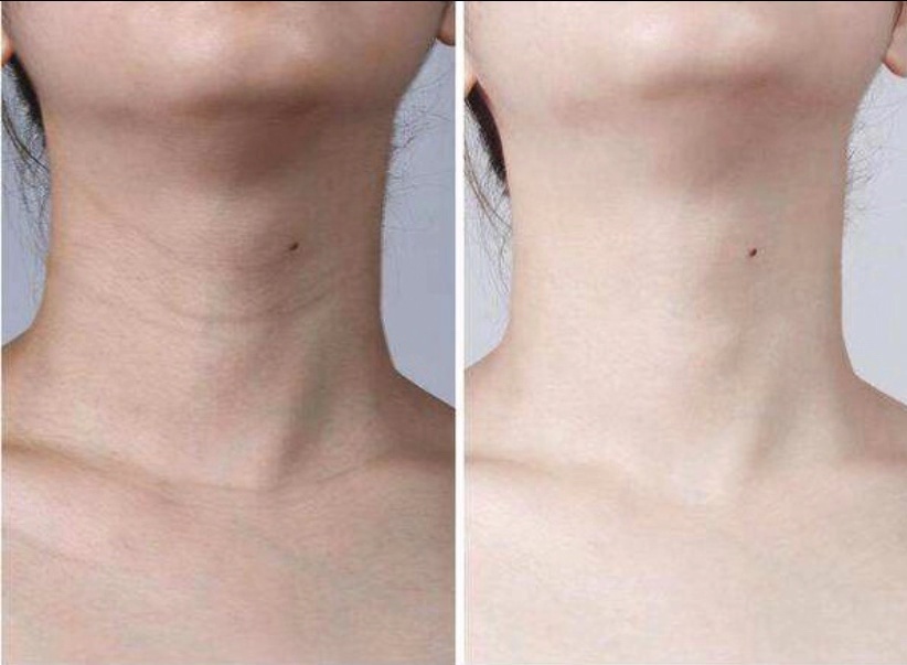 去脖子颈纹最好的方法真实有效,去脖子后颈纹最好的方法