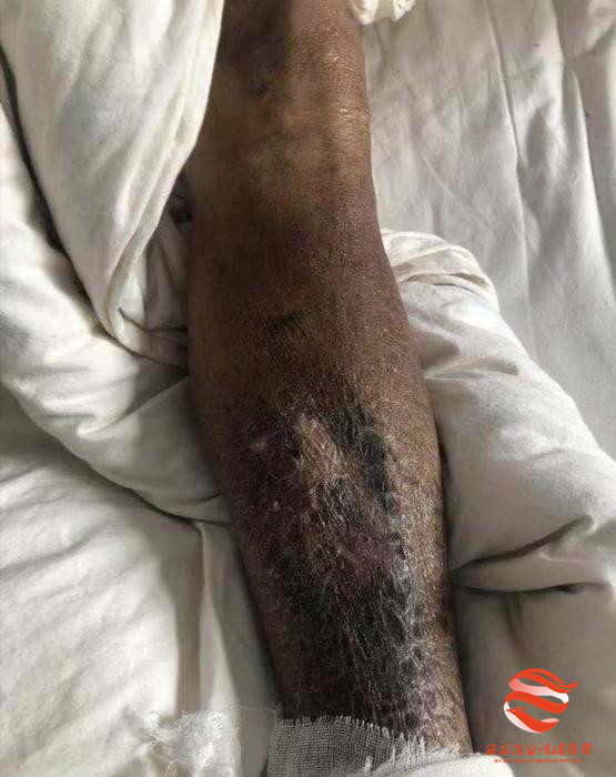 静脉曲张综合征常见皮肤表现,布加氏综合征与静脉曲张有关系吗