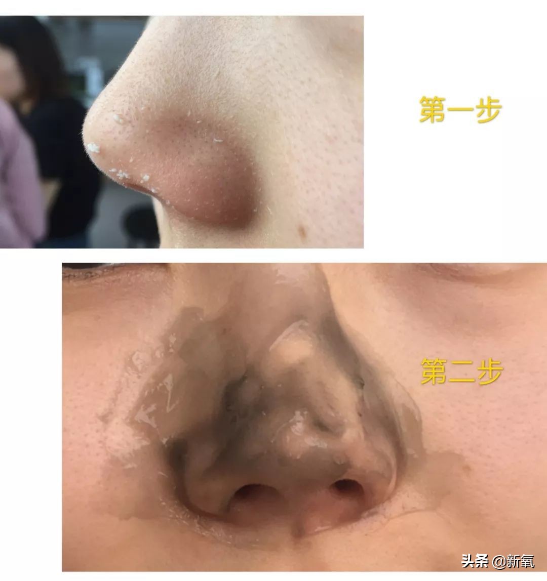 去黑头最有效的方法一个月见效,别挤了教你去黑头的正确方法