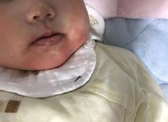 宝宝湿疹严重妈妈吃什么食疗,湿疹的分类及应对方法