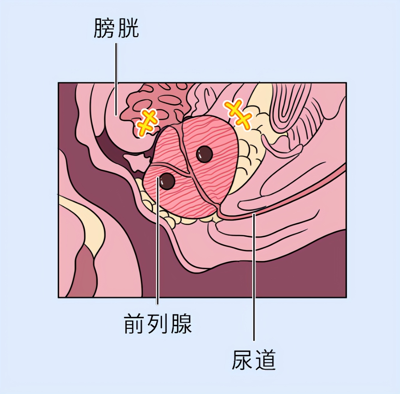 男性得了前列腺会影响生育吗,前列腺疾病能生育吗
