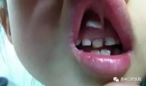 乳牙蛀牙清除真实全过程,小儿乳牙龋齿民间治疗偏方