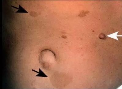 「热点资讯」臀部长胎记似恐龙，这个英国小妹火了