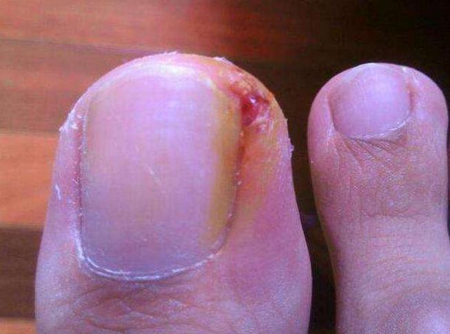 甲沟炎灰指甲脚气的区别,脚气灰指甲甲沟炎挂什么科