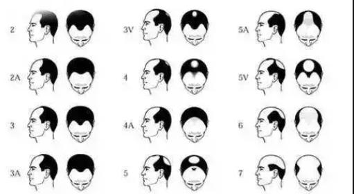 二十八岁头发开始秃有救吗,二十八岁头发掉光