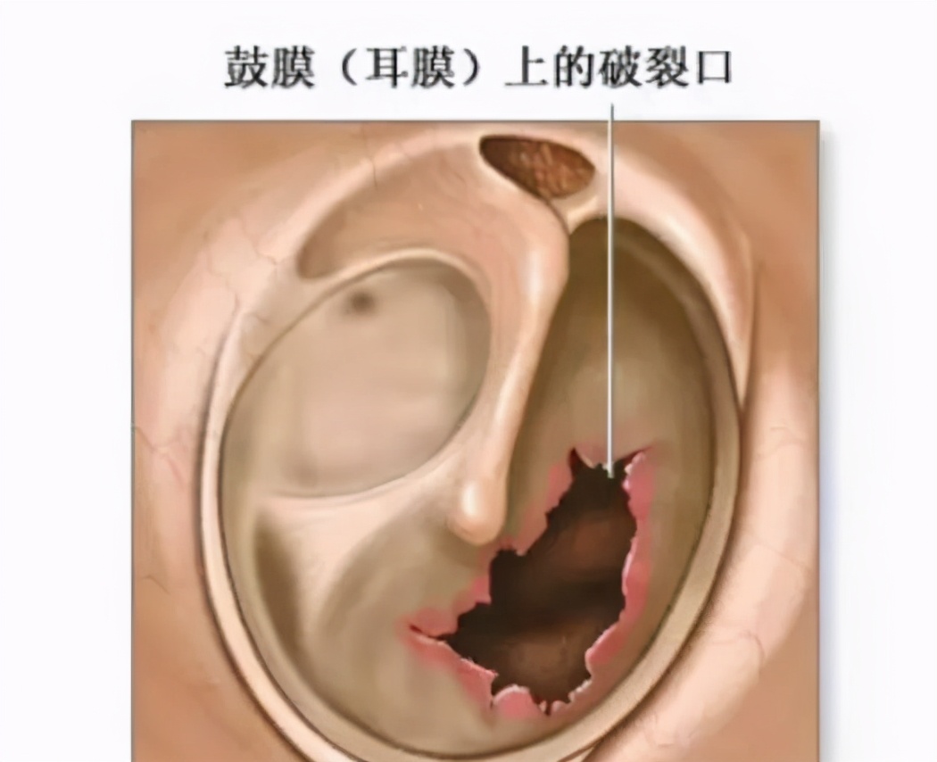 掏耳朵会导致鼓膜穿孔吗,掏耳朵导致鼓膜穿孔能自愈吗
