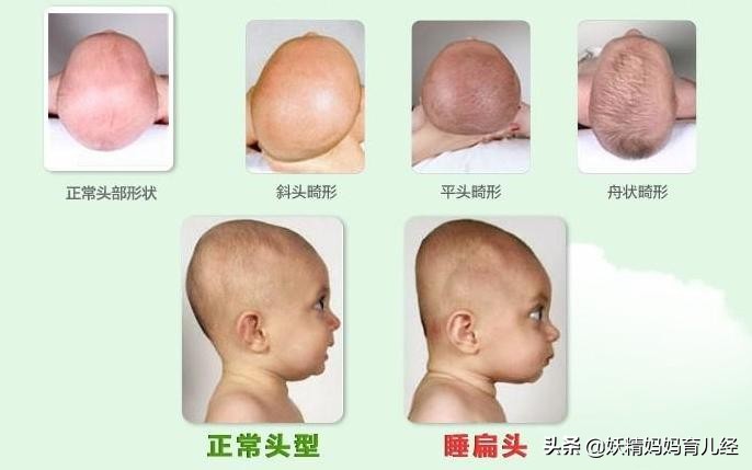 宝宝头型睡凹了怎么矫正,婴儿头型睡扁了纠正方法