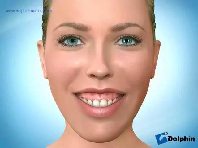 笑露牙龈怎么整,笑露牙龈怎么矫正训练