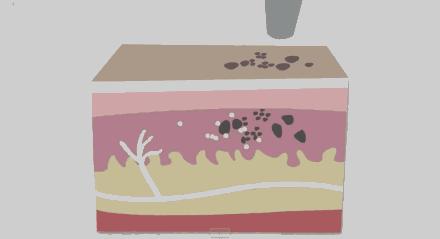 激光祛纹身的正确方法,激光快速祛纹身方法