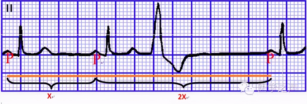 什么是窦性心律失常,什么是心律早搏