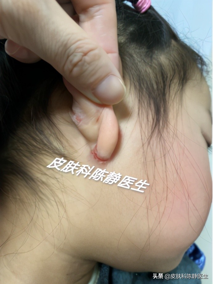 求治宝宝湿疹方法,宝宝湿疹给宝妈支招