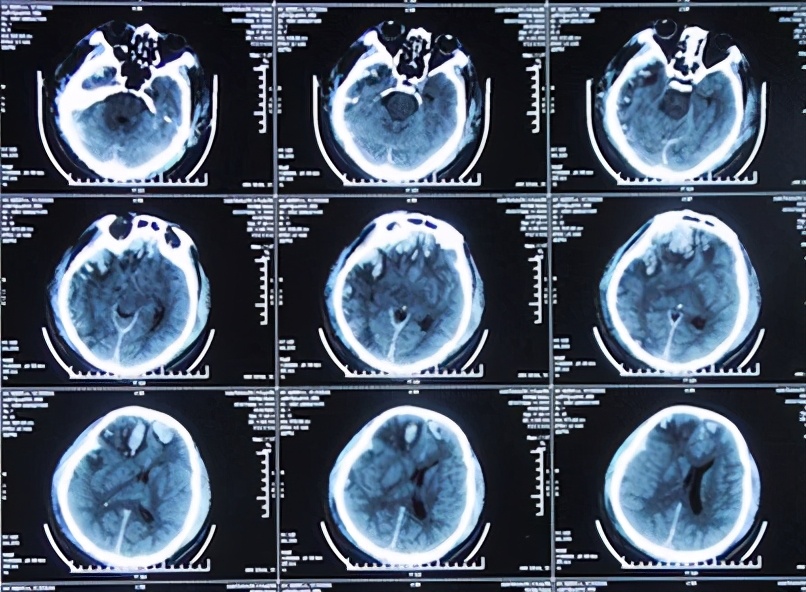 脑外伤开颅手术后脑积水,脑外伤手术后脑脊液鼻漏怎么治疗