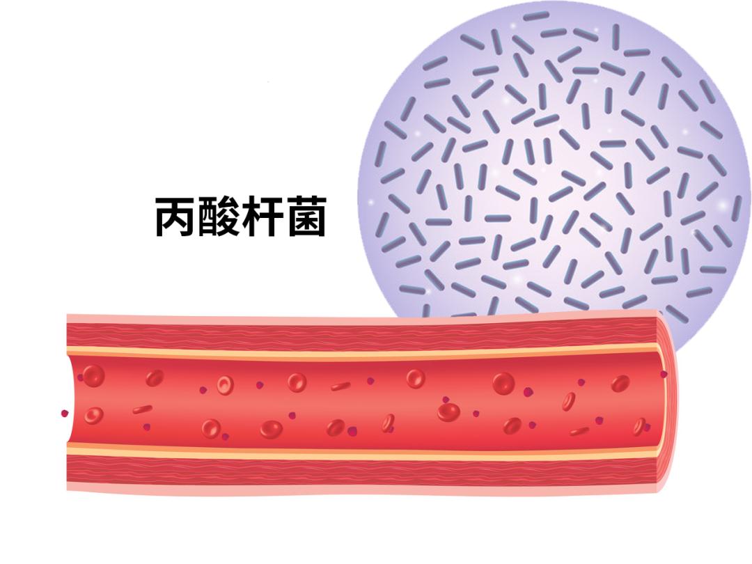 大学生挤痘痘引发的惨剧,女生挤痘痘导致面部感染