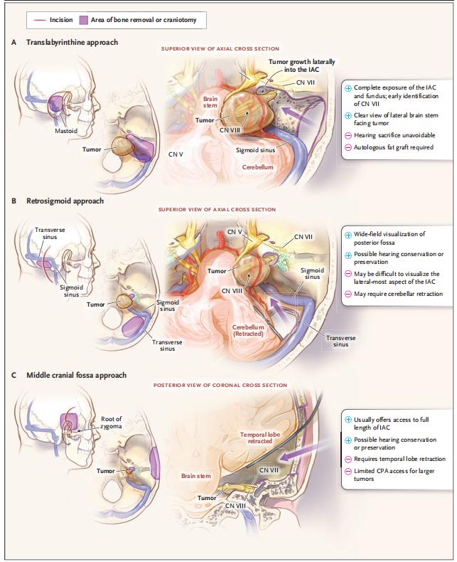 听神经瘤最新论文,听神经瘤的前沿研究