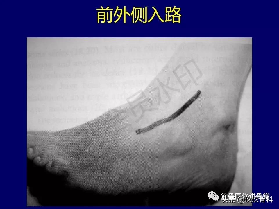 距骨骨折的治疗原则,距骨骨折如何调理