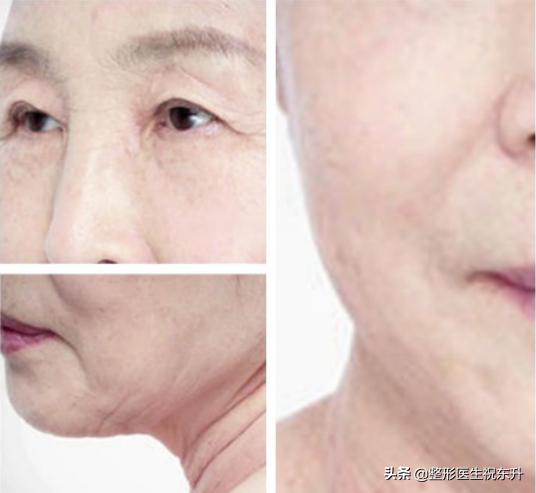 55岁如何做面部提升术好,40岁适合哪种面部提升手术