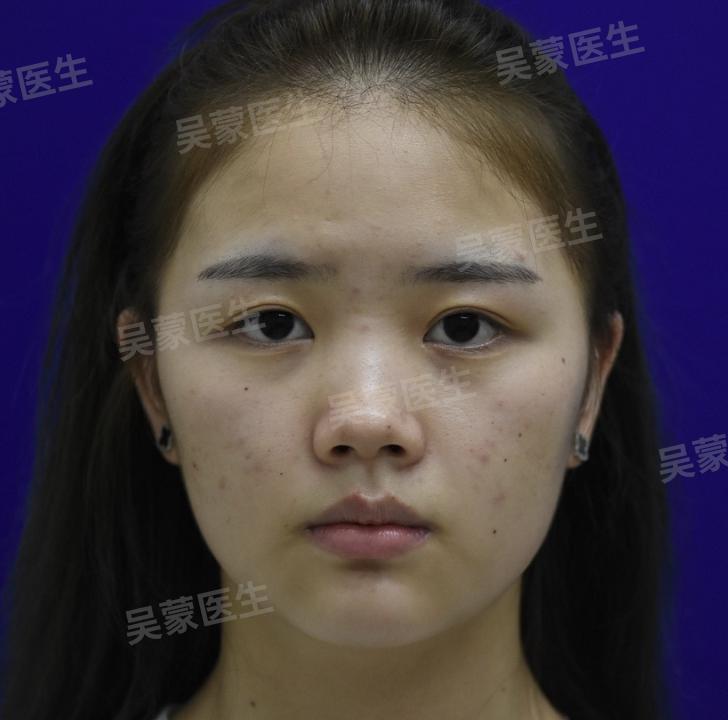 鞠婧祎鼻子整过吗,鞠婧祎的鼻子整过吗