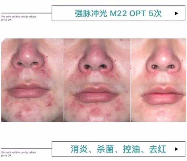 酒渣鼻有什么特效药,酒渣鼻的原因及治疗