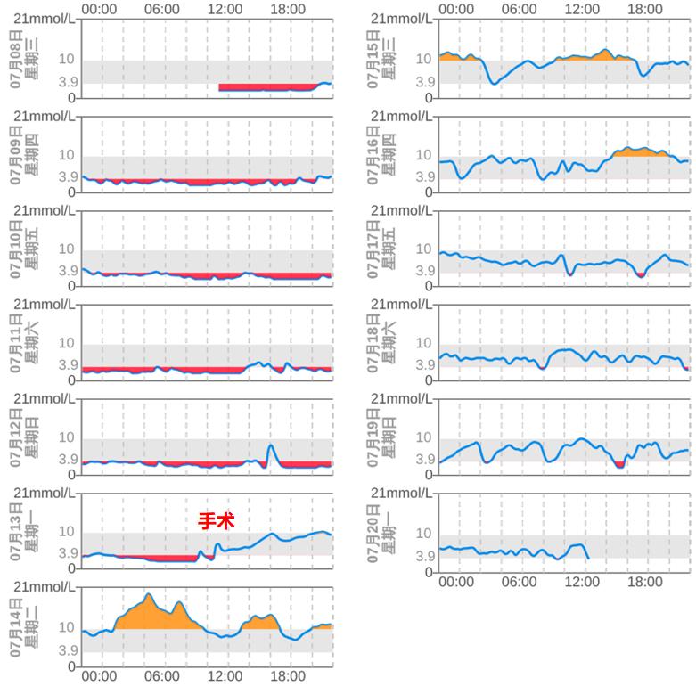 反复低血糖是肿瘤吗,读报反复低血糖警惕胰岛素瘤