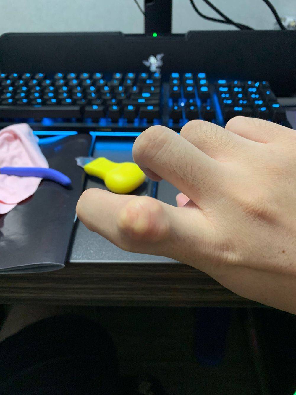 痛风结节怎么治疗最有效,痛风关节炎的治疗办法