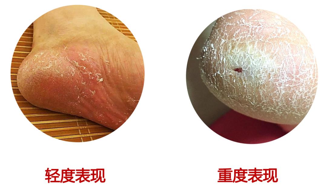 及时治疗脚气，是对家人最好的负责