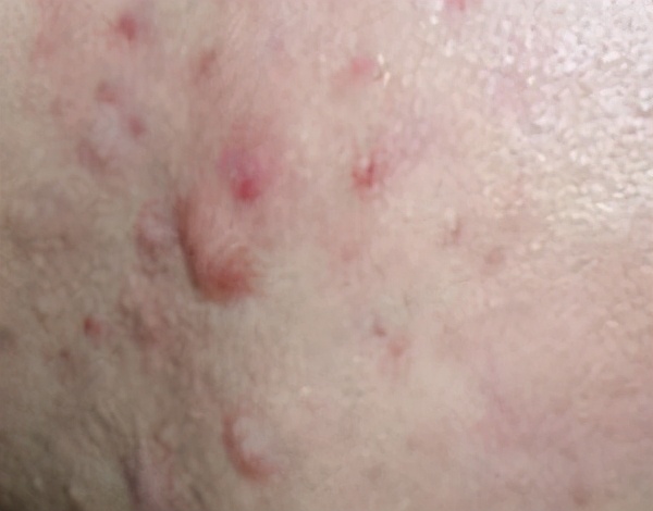 增生黑痘印疤痕凸起怎么治,凹陷性痘印不消能用药膏修复好吗