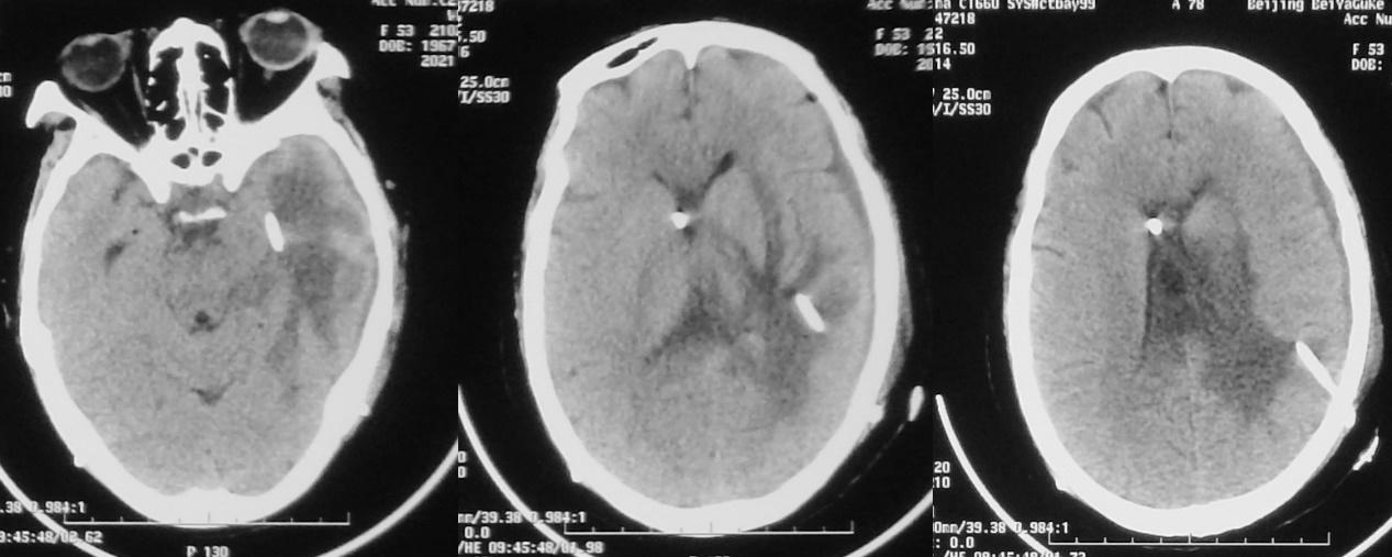 脑脓肿合并脑膜炎需要手术吗,脑脓肿进入左侧脑室严重吗