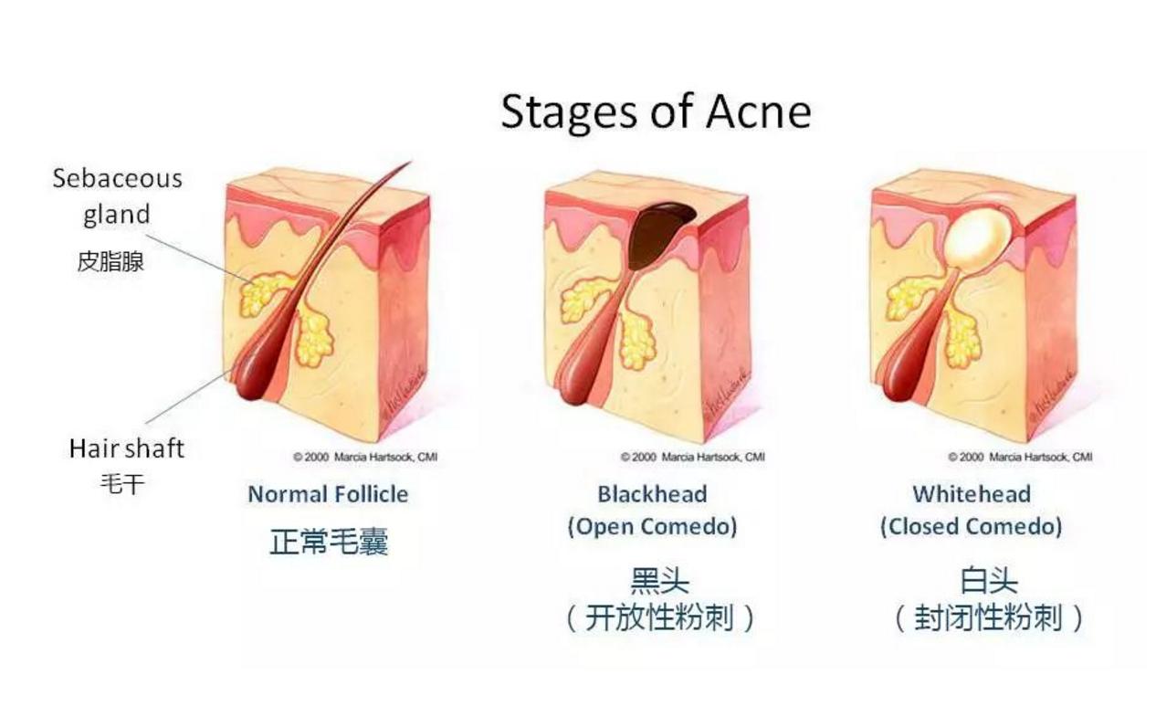 额头闭口反反复复怎么办,额头反反复复长闭口粉刺怎么办