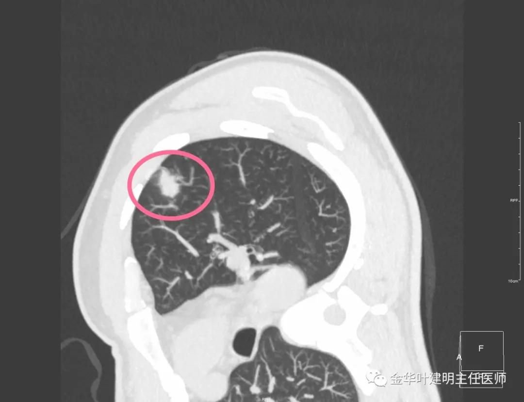 叶建明谈肺结节:一招分辨隐球菌性肉芽肿与肺癌