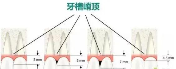牙齿黑三角怎么补救,牙齿上的黑三角怎么改善