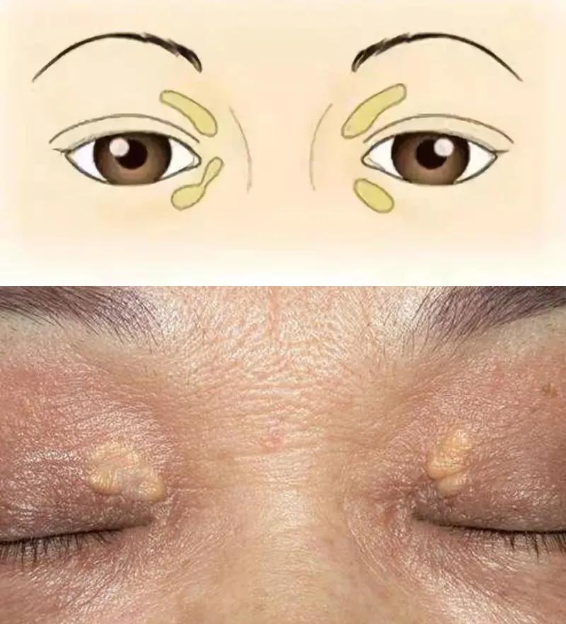 心脏引起的眼皮肿的图片,心血管病人眼睛充血怎么回事