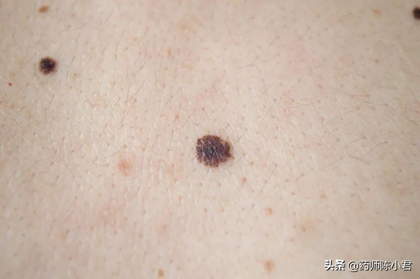 脚底黑痣癌变能治好吗,脚底黑痣割掉之后会再长出来么