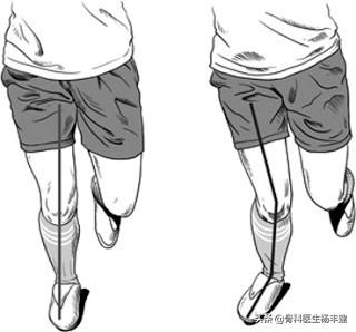 老年人常见的髋部损伤有哪些,跑步的常见损伤之髋关节