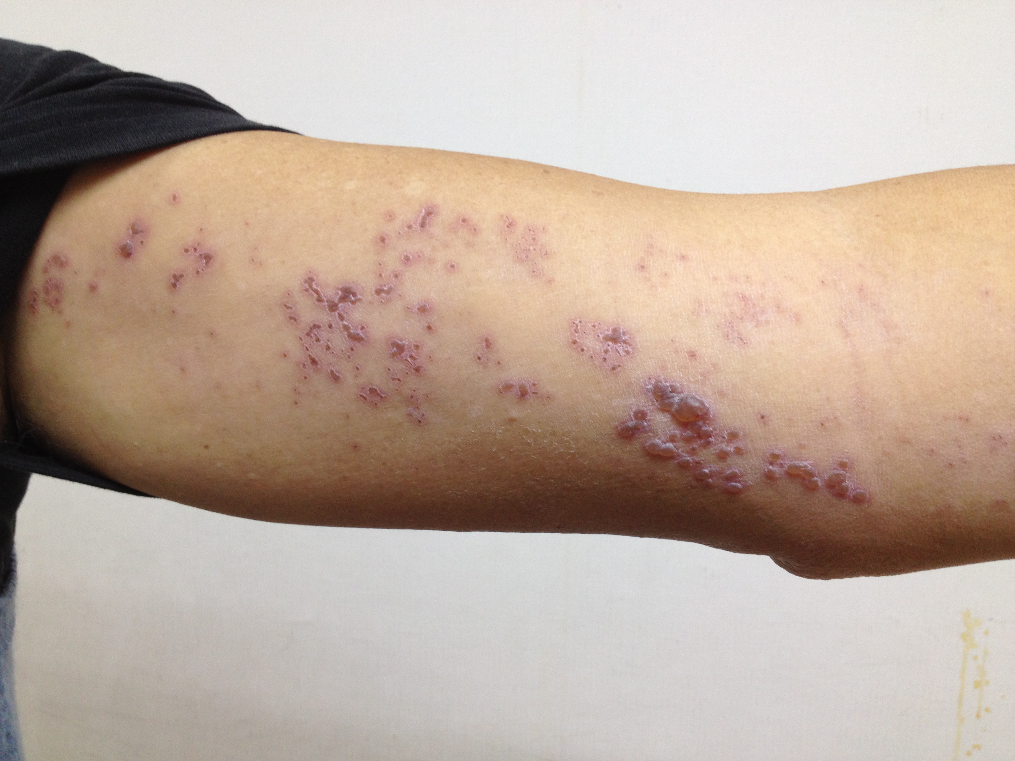 门诊日记全集,带状疱疹入院记录范文