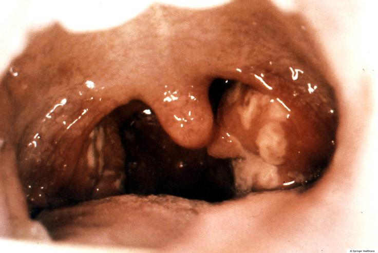 治疗扁桃体最好的方法是什么,讲解一下扁桃体的作用