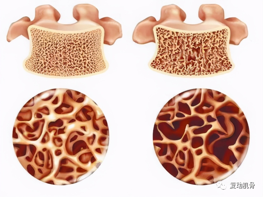 骨折21天自行拆石膏,骨折保守治疗打石膏是愈合得快吗