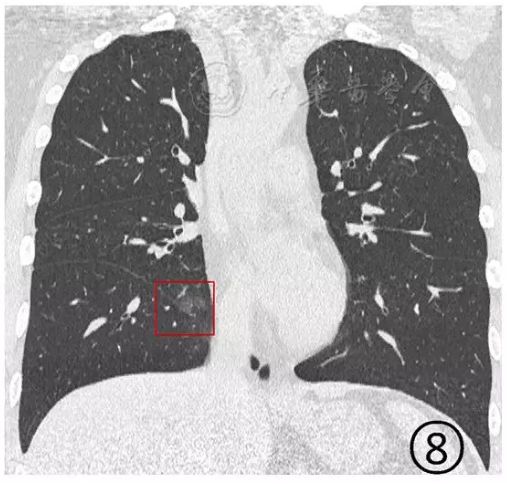 磨玻璃阴影怎么处理,磨玻璃阴影