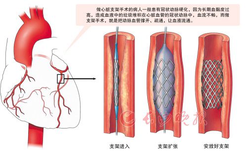 支架术后五年后气短咋办,胆管支架术后疼痛几天能消失