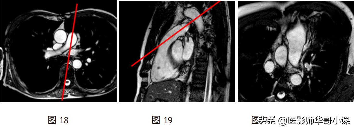 磁共振心脏扫描标准切面,心脏mri扫描定位