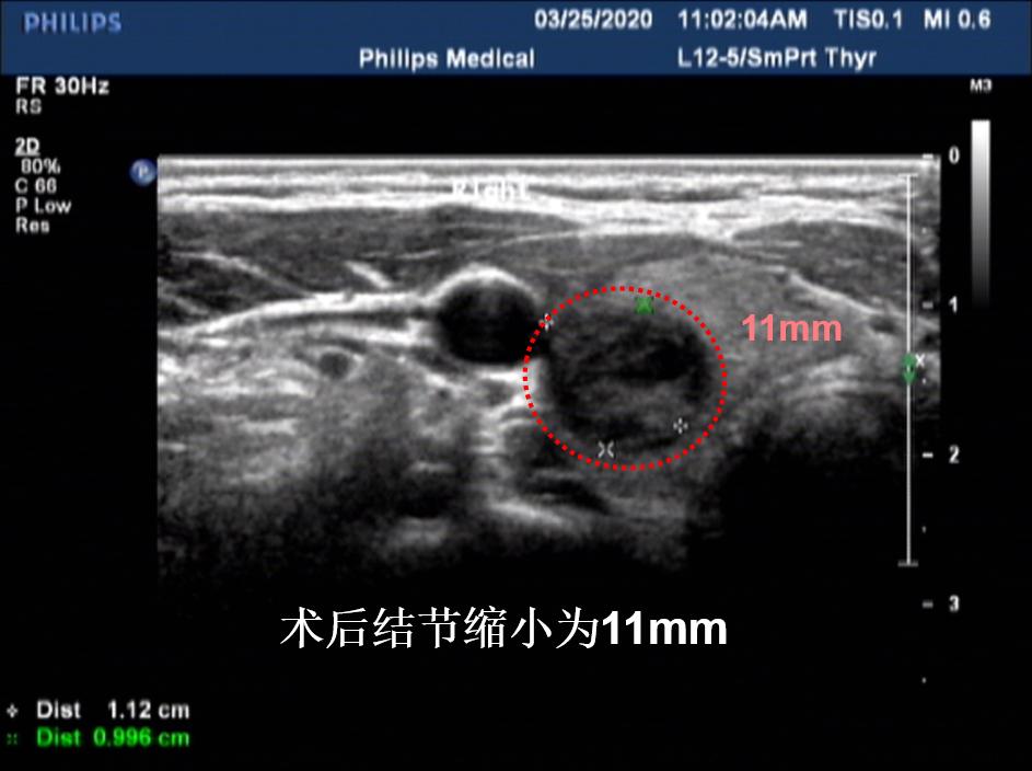 甲状腺结节微创消融手术,甲状腺结节微创消融医保