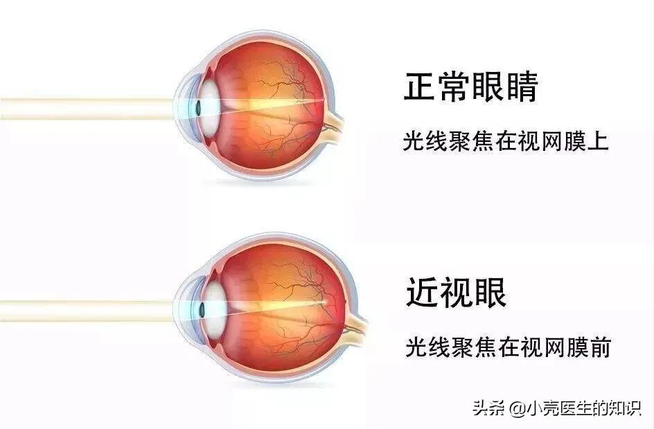 游泳可以预防近视吗,近视能经常游泳吗