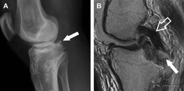 常见的八种骨折,容易漏诊的肩关节骨折