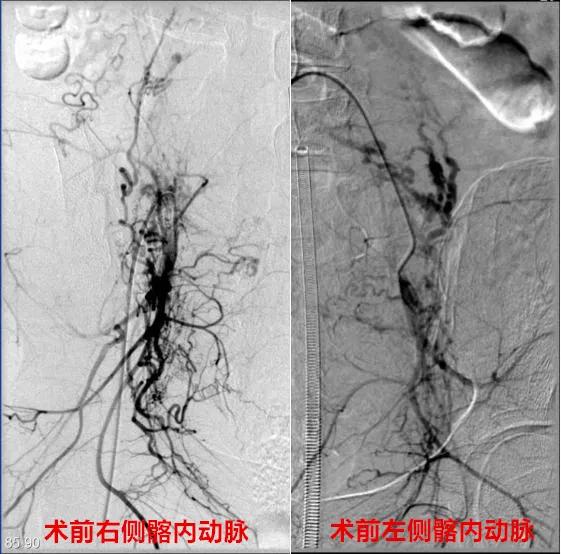 一产妇手术台上大出血死亡,一产妇大出血急需血小板去世