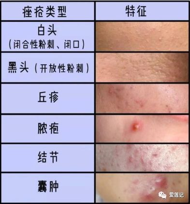 痘疮症状,战痘中的痘痘是什么