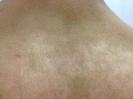 不是所有白斑都是白癜风,是不是所有的白斑都是白癜风