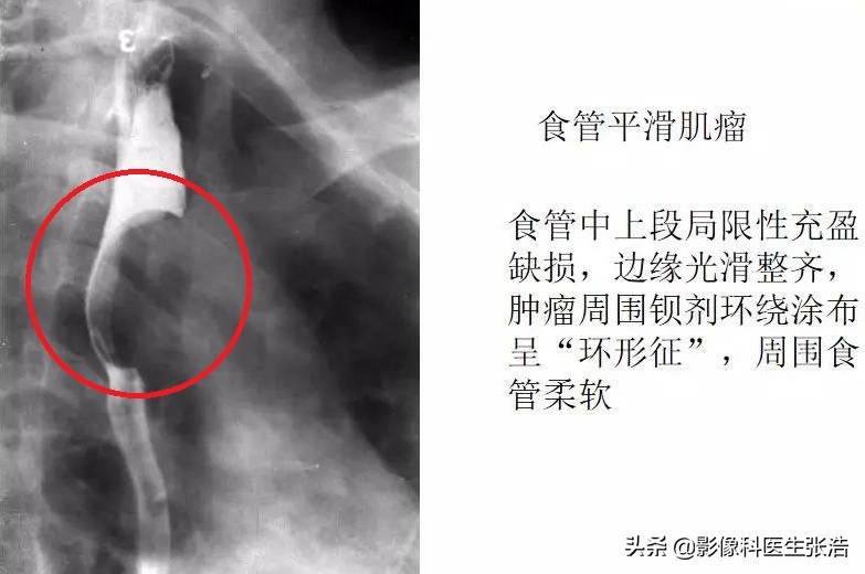 胃钡餐能看到食道问题吗,食道有问题钡餐能查出来吗